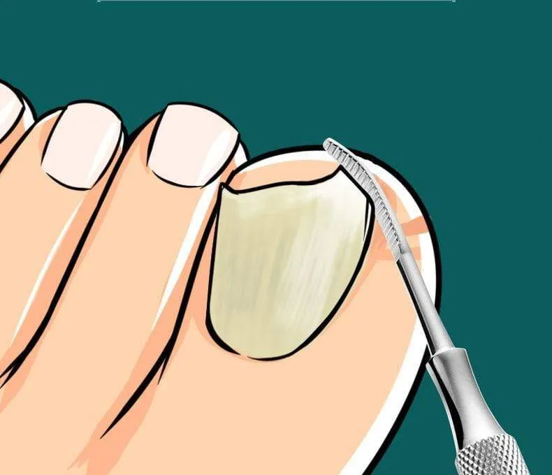 Nagelwerkzeuge Fleckstahl Werkzeug für eingewachsene Nägel Abgestorbene Haut schieben
