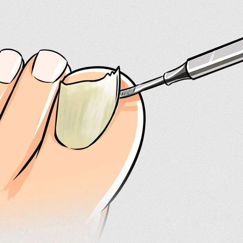 Nagelwerkzeuge Fleckstahl Werkzeug für eingewachsene Nägel Abgestorbene Haut schieben